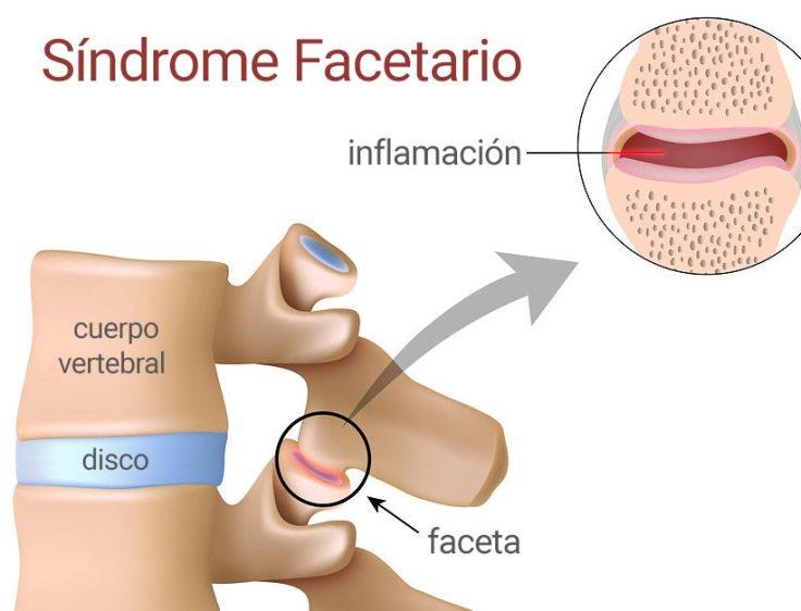 sindrome-facetario